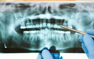 root canal