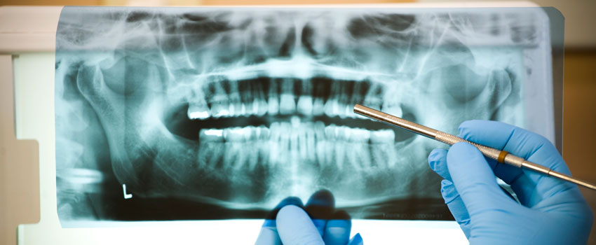 root canal