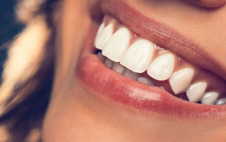 veneers